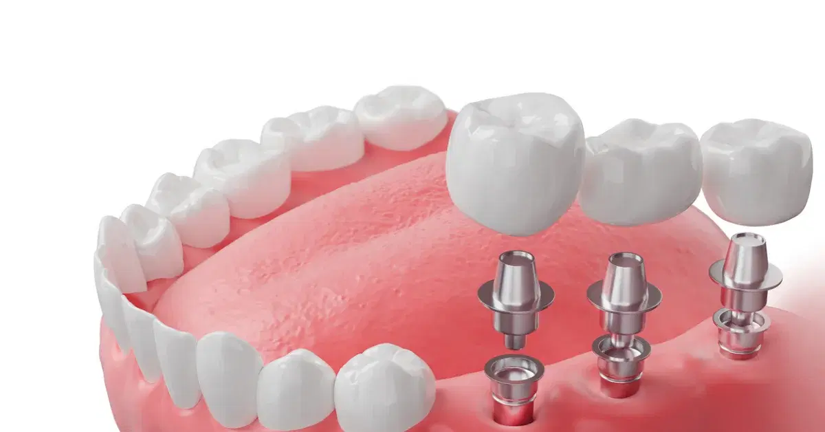Zirconia Dental Implants Pros and Cons