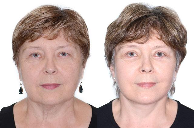Face Lift Surgery, Upper and Lower Eyelid Surgery