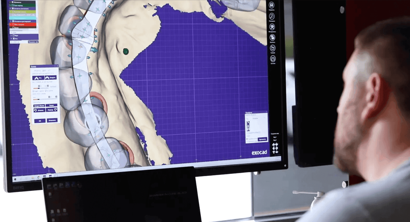 Gentle Care at Fusion Dental Implants El Dorado Hills