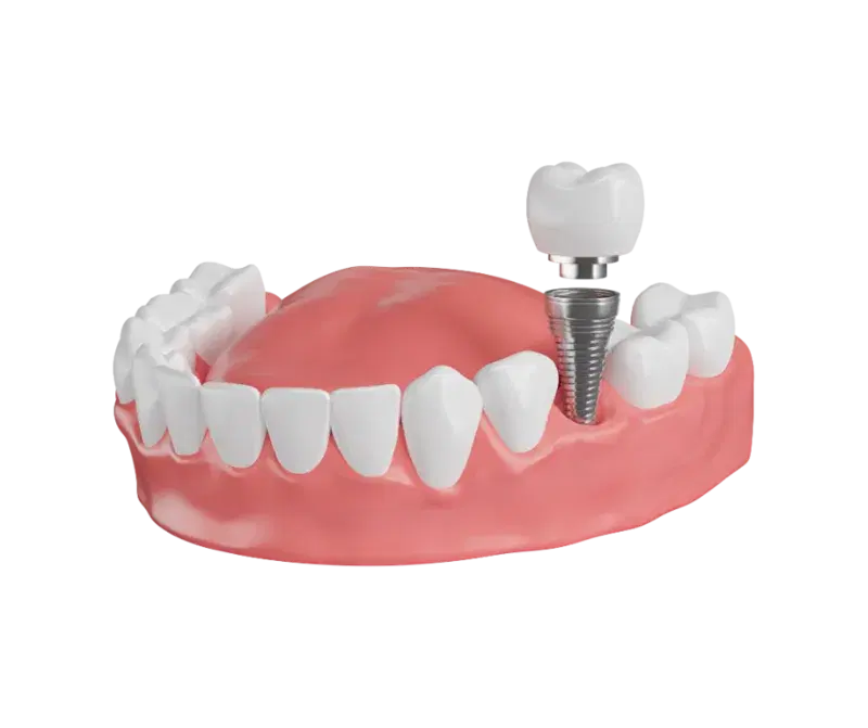 Single Tooth Implant