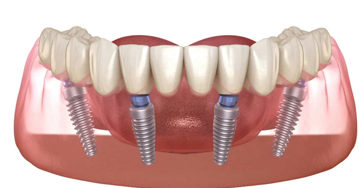 All-on-4 vs all-on-6 – full-arch dental implant bridge supported by multiple implants in jaw illustration