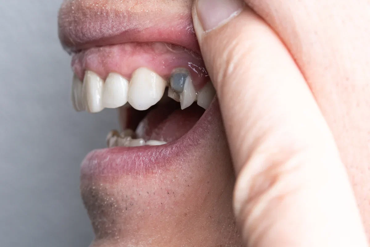 Dental Implant Infection Signs: When to Call Your Dentist image