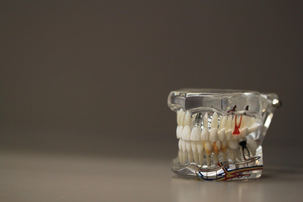How Implant-Retained Teeth Beat Traditional Dentures