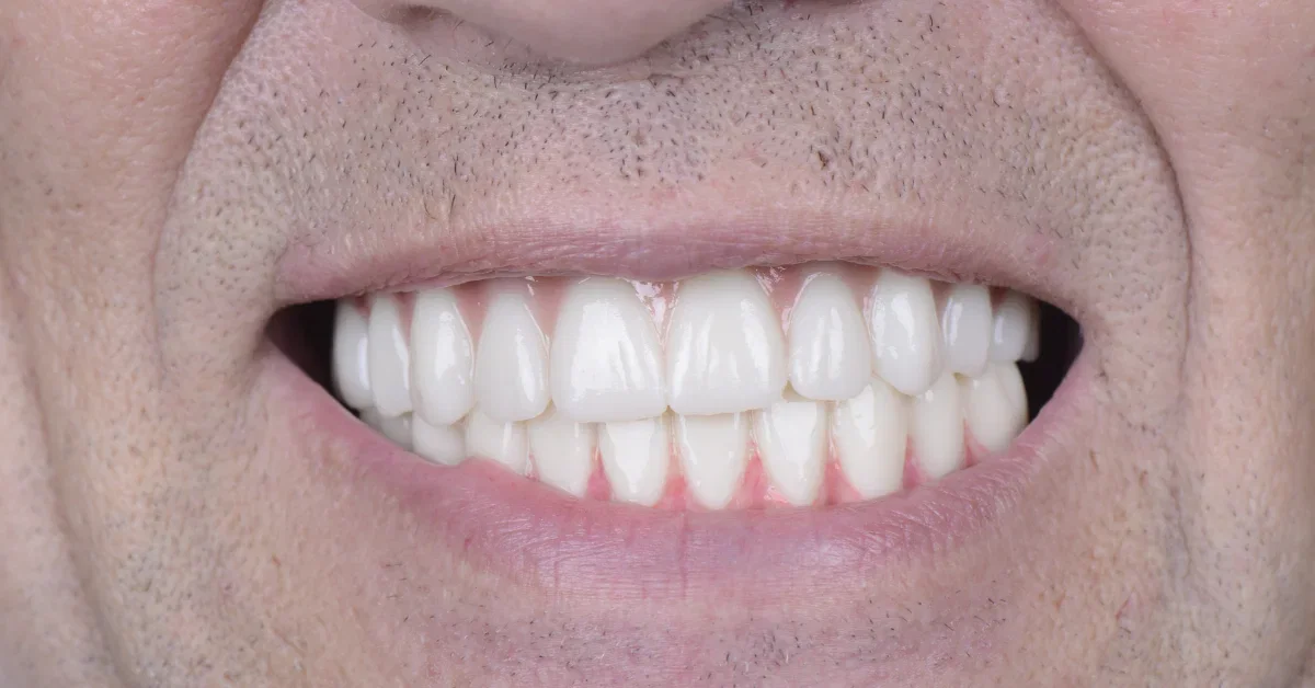 Soft Food Diet After Dental Implants: What to Eat and Avoid image