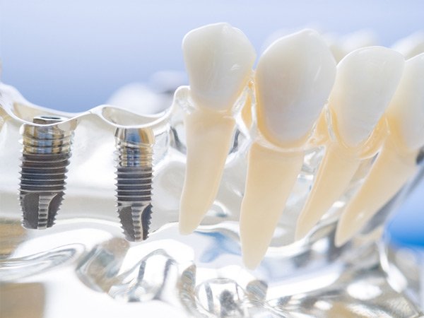 Diga Adiós a las Dentaduras: Descubra los Implantes Dentales de Vanguardia de 2024