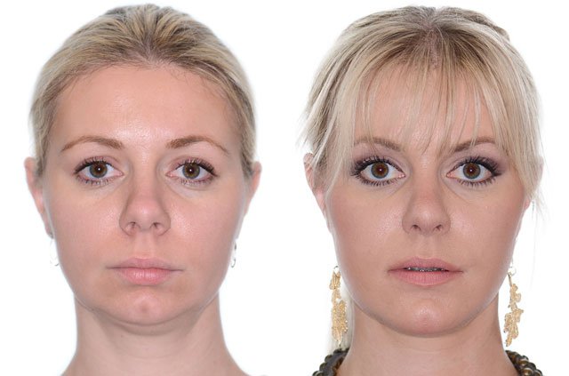 Corrective Jaw Surgery Complete Face Makeover