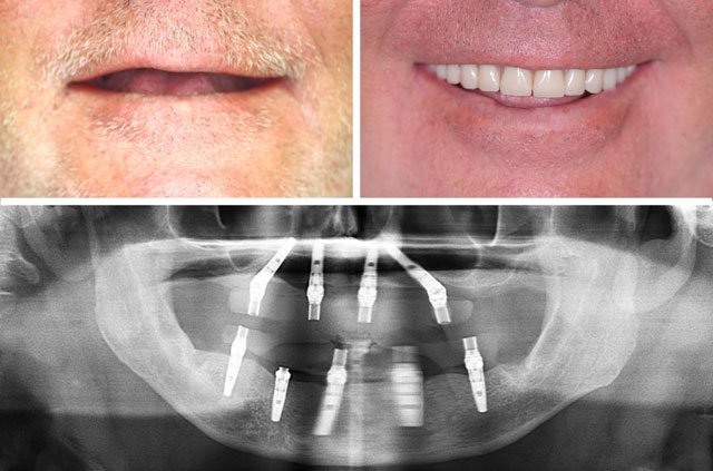 Immediate Implants and Teeth All-On-4