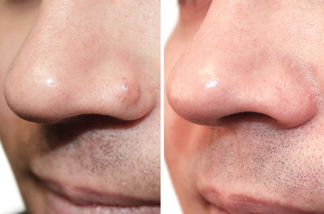 Scarless Mole Removal from the Nose