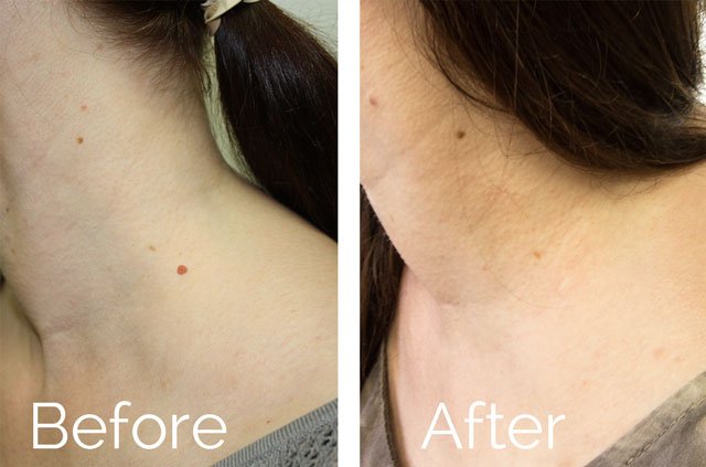 Neck Scarless Mole Removal