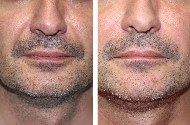 Dermal Fillers Juvederm