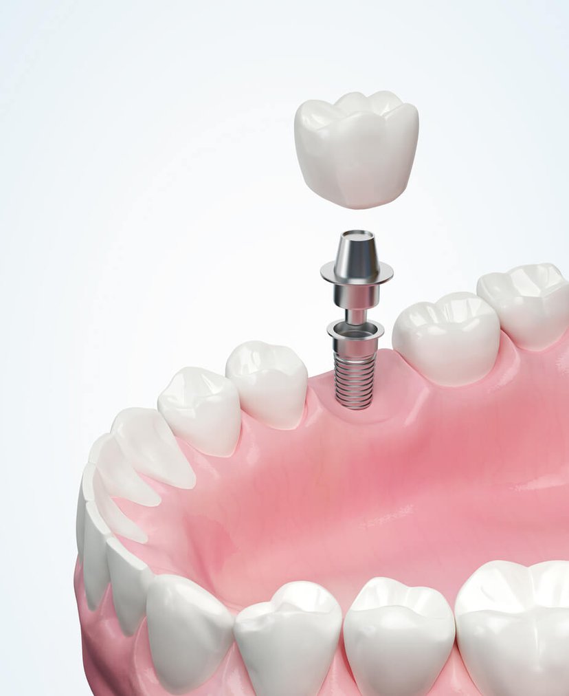 Individual dental implant with titanium post and porcelain crown at Fusion Dental Implants Roseville CA