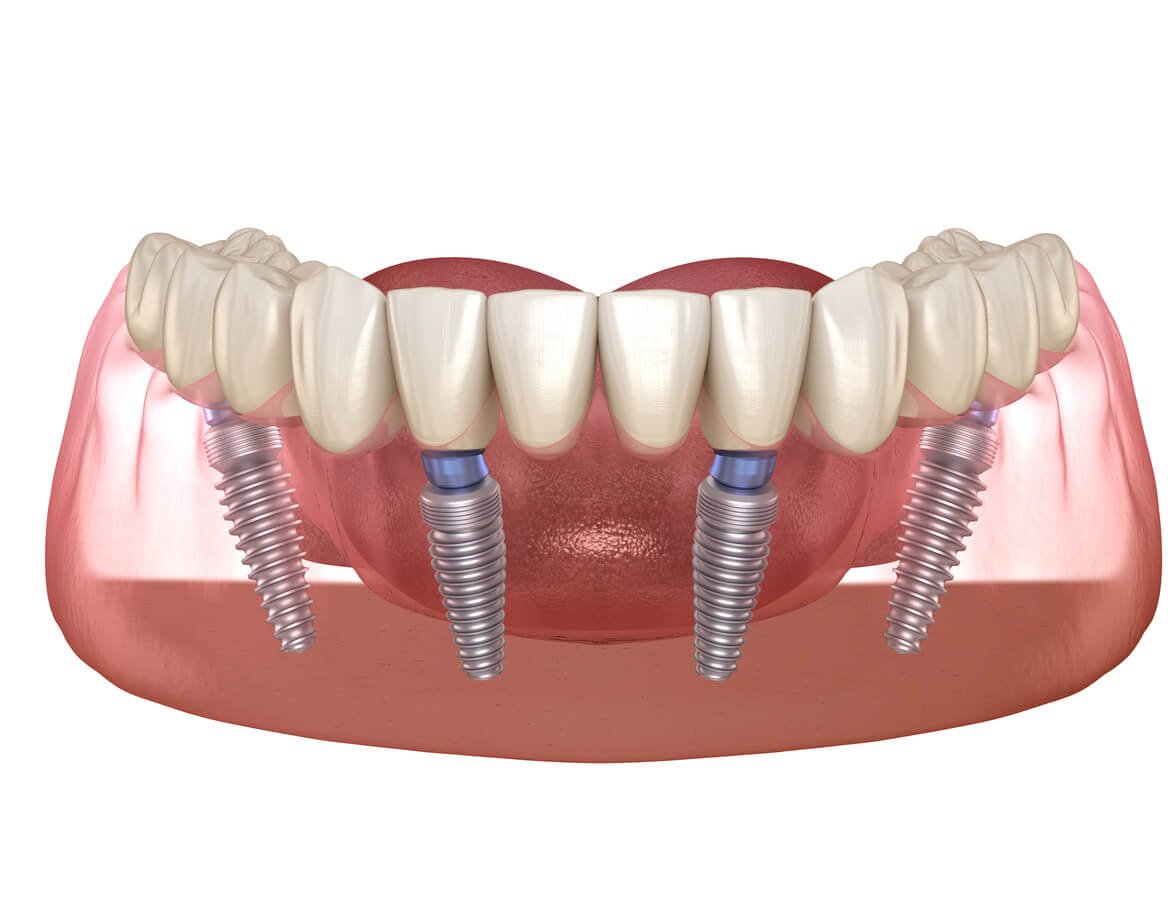 All-on-4 dental implant procedure at Fusion Dental Implants Roseville CA