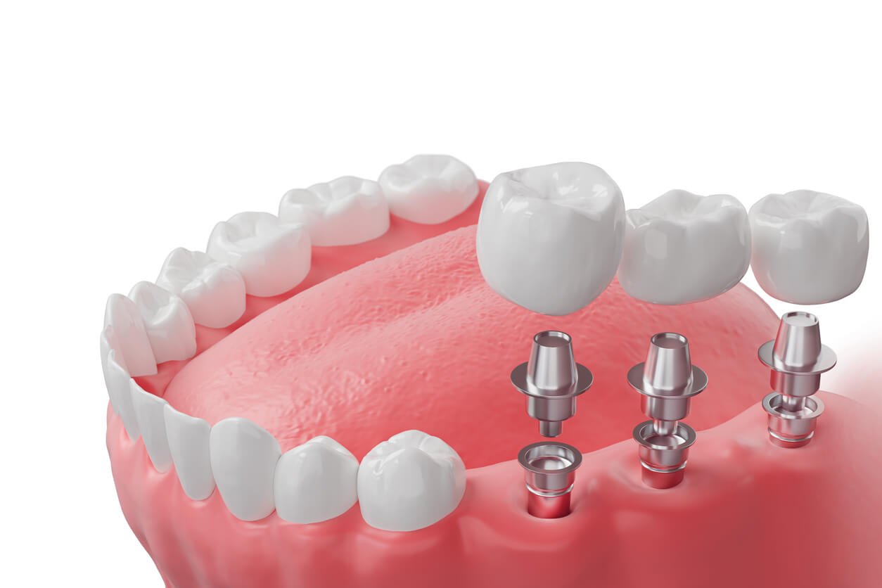 Multiple dental implants treatment at Fusion Dental Implants Sacramento CA