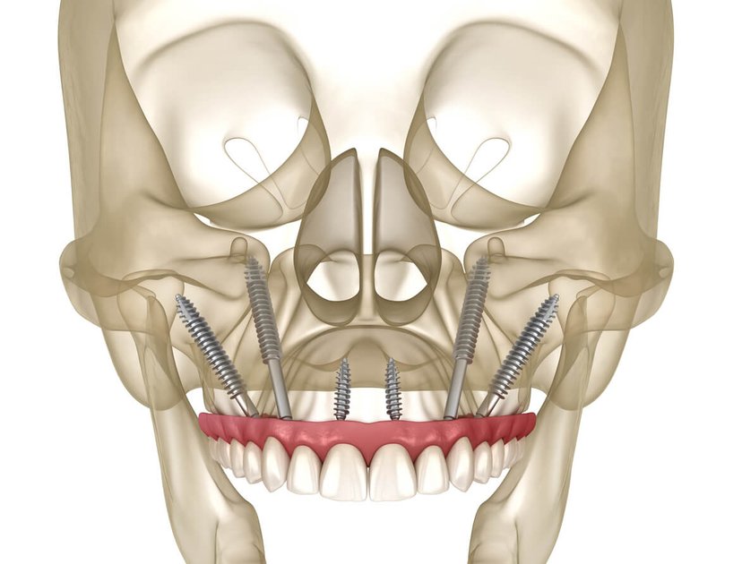 Fusion ZYGO Zygomatic