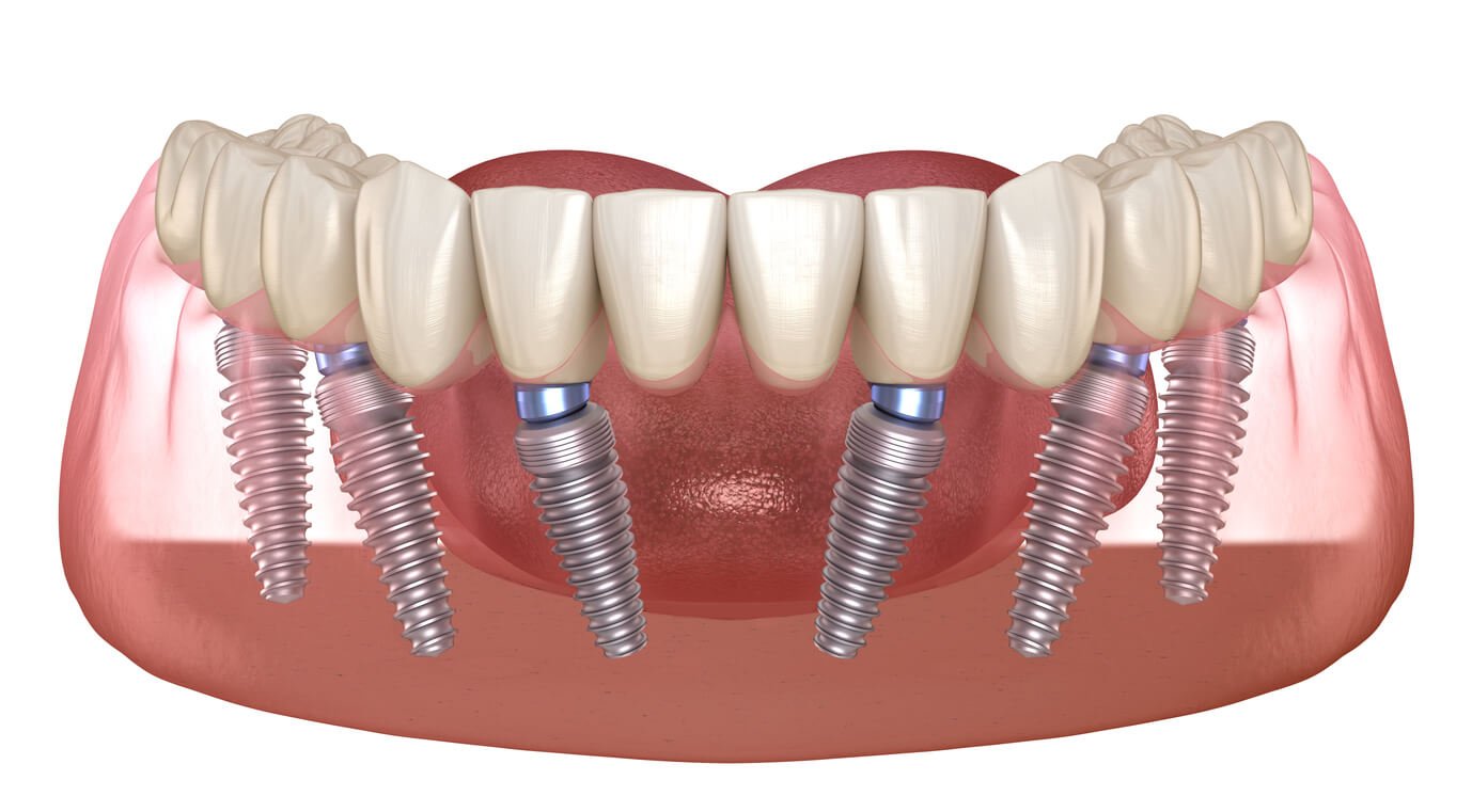 All-on-6 dental implant solution at Fusion Dental Implants Sacramento