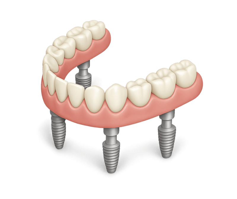 Dental bridge implant solution at Fusion Dental Implants