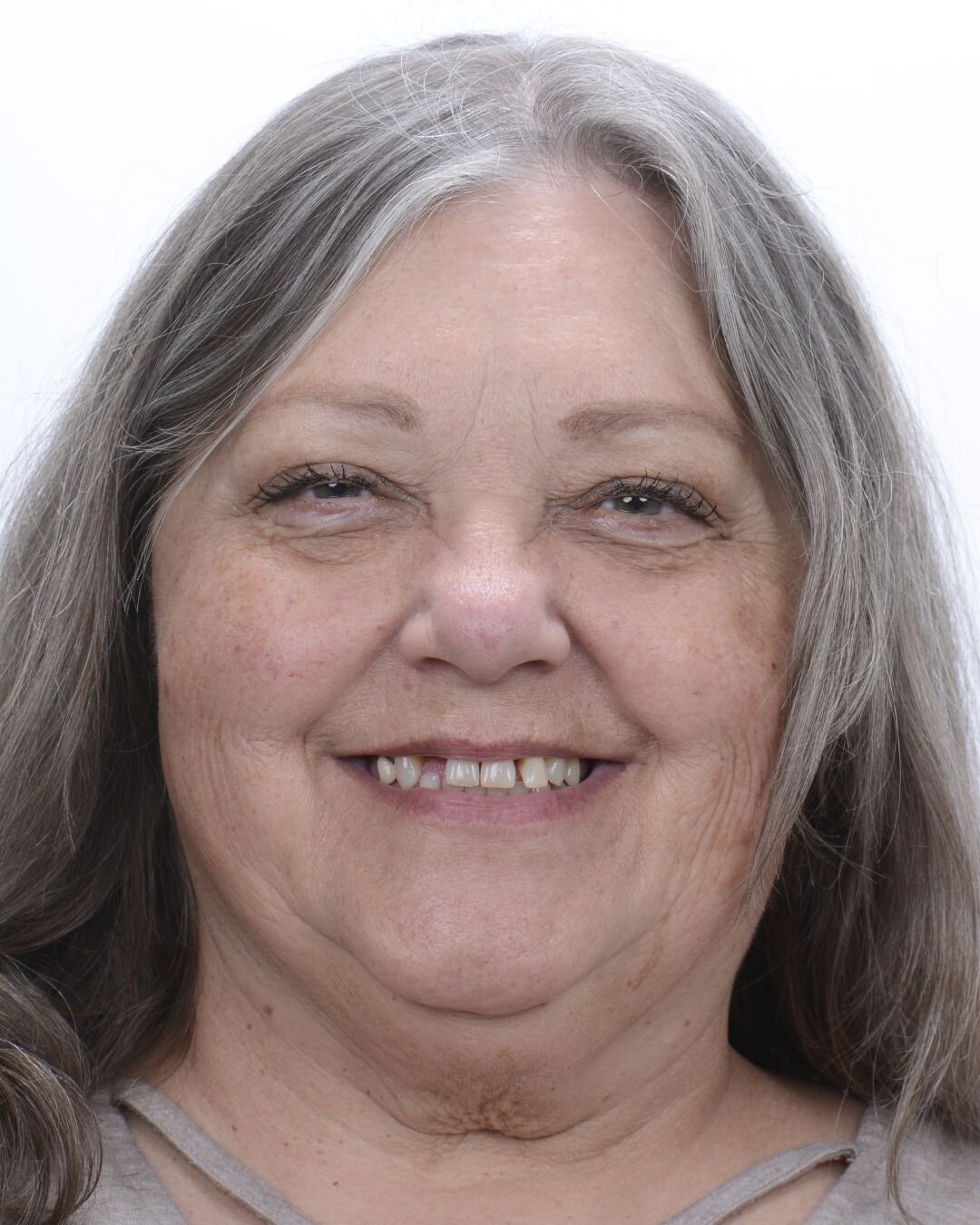 Patient before dental implant transformation at Fusion Dental Implants Roseville CA