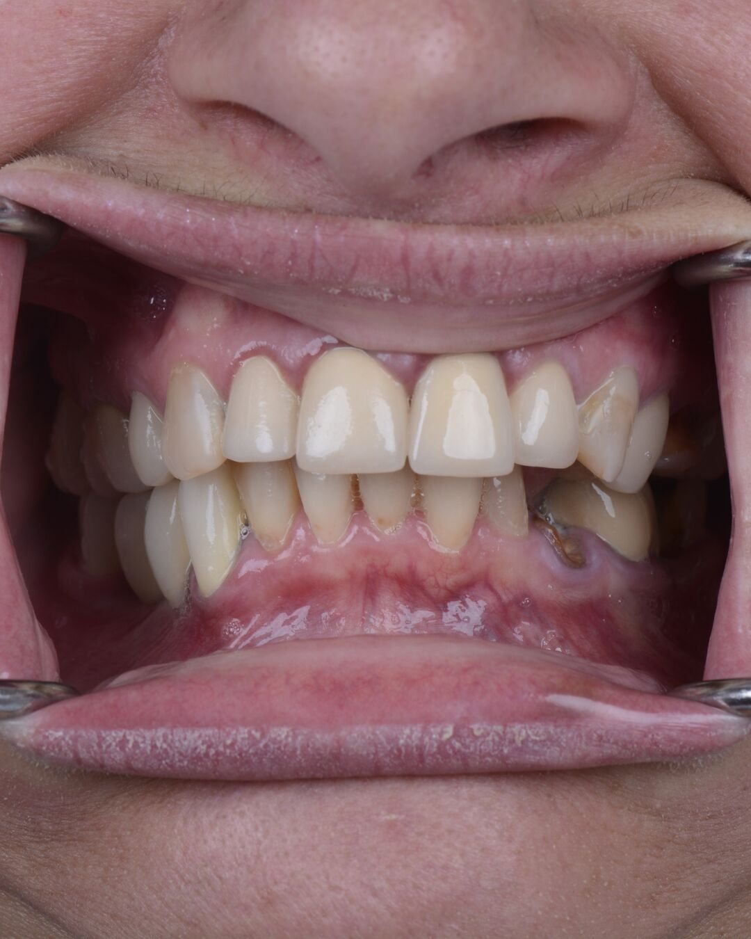 Close-up of teeth before dental implant treatment at Fusion Dental Implants