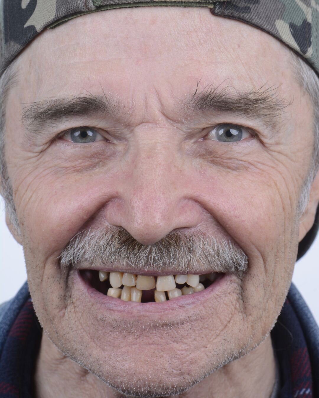 Patient 2 before dental implant procedure at Fusion Dental Implants Sacramento