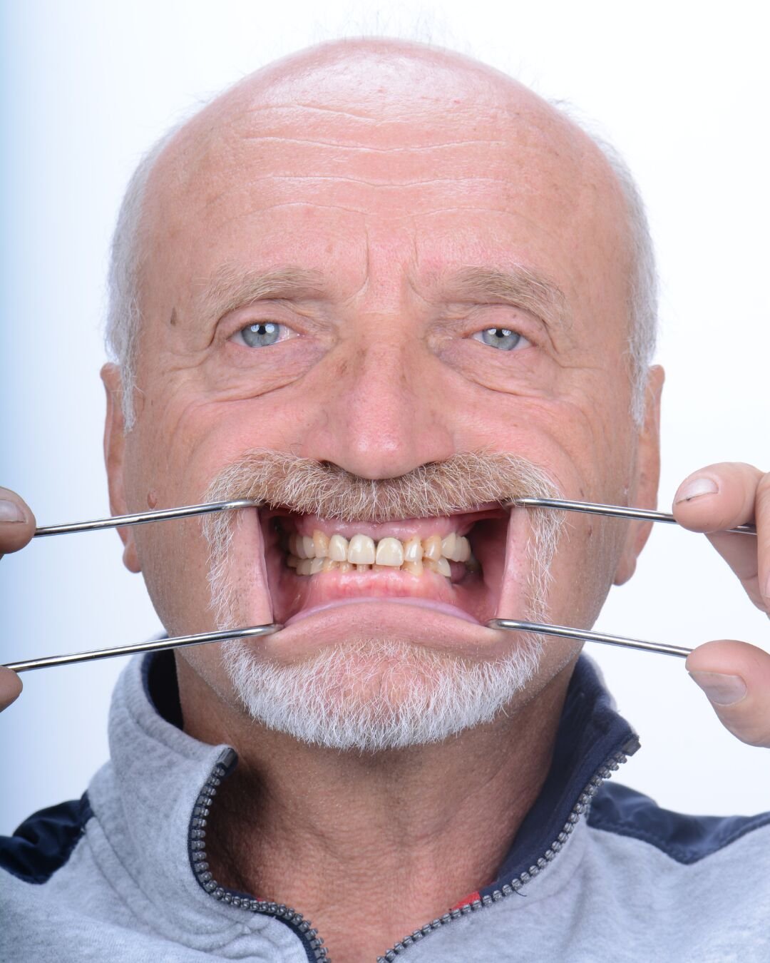 Patient 4 before dental implant treatment in Roseville California