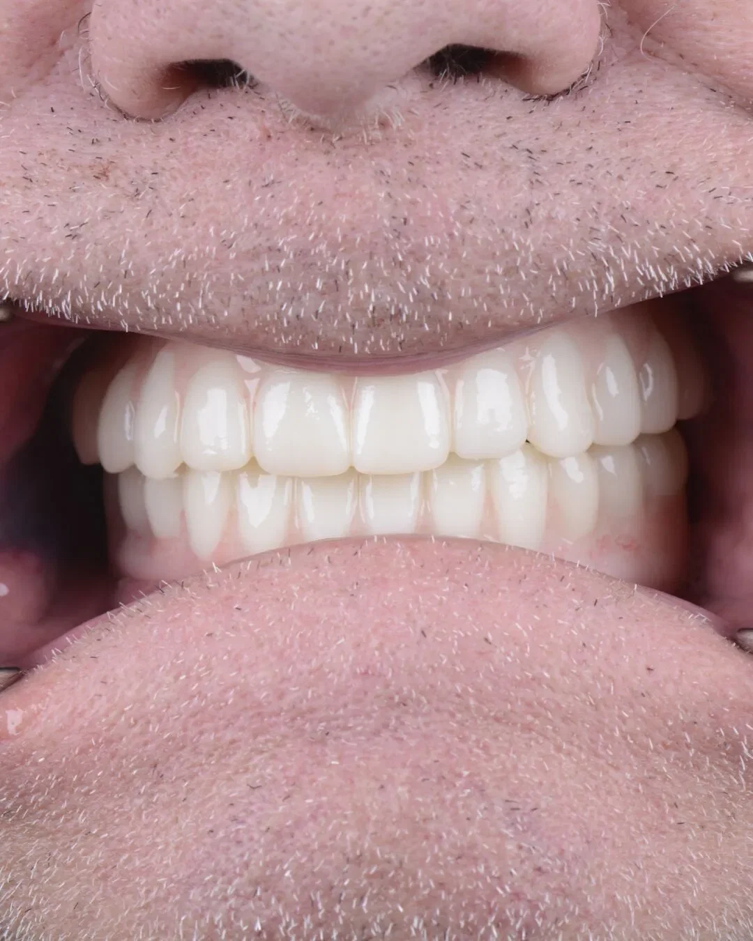 After teeth close-up - Dental implant transformation - life-changing results