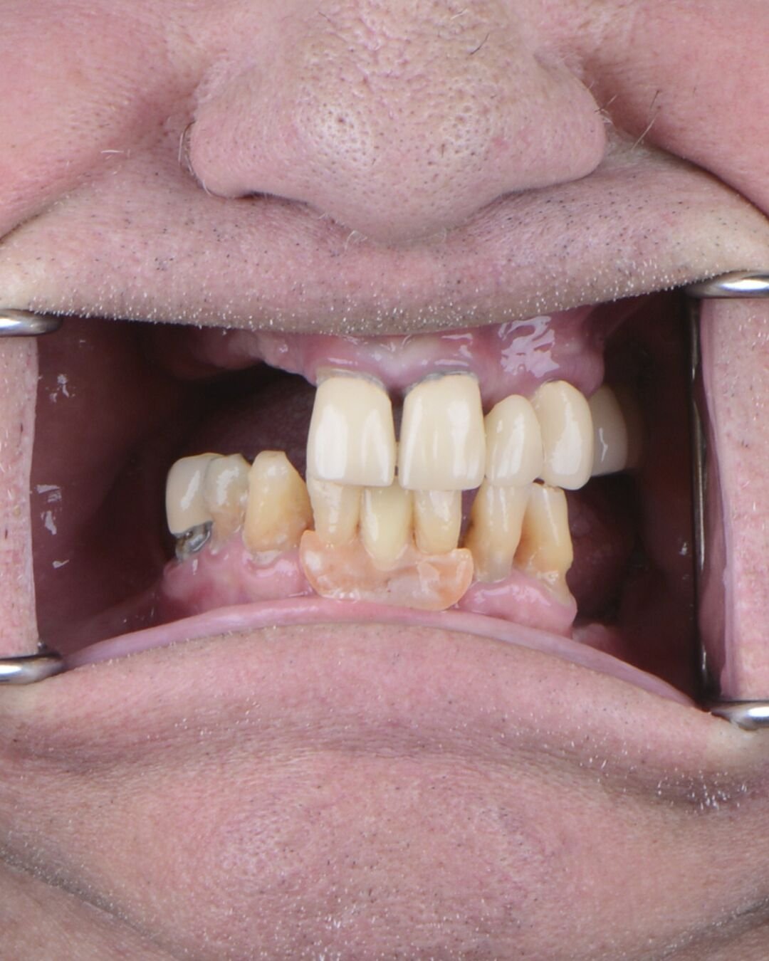 Close-up of patient 4 teeth before implant restoration