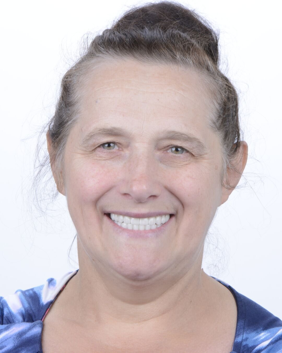 Patient 5 after smile makeover with beautiful dental implants