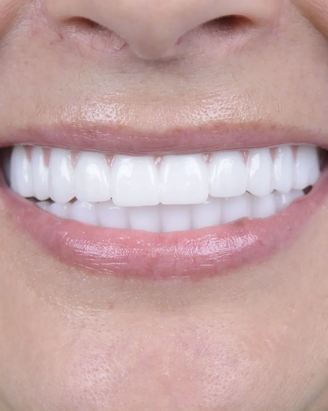 After teeth close-up - Dental implant transformation - beautiful new smile