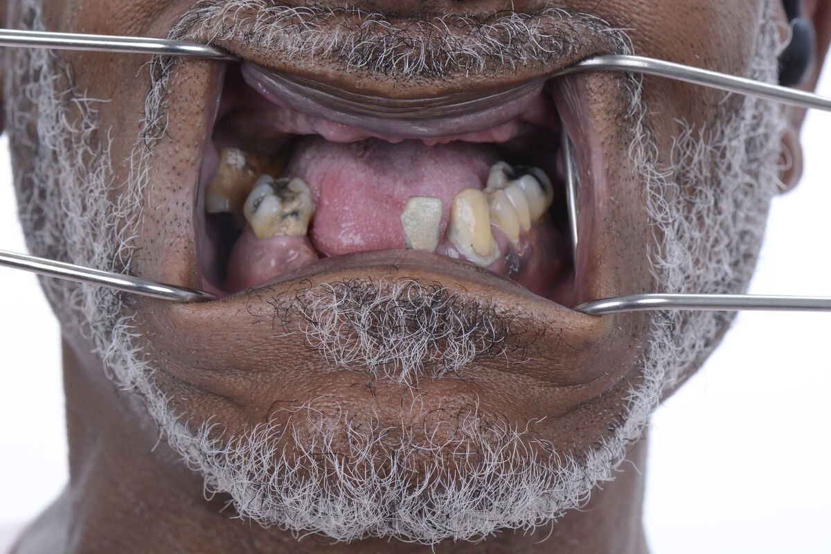 Patient 6 teeth close-up before treatment