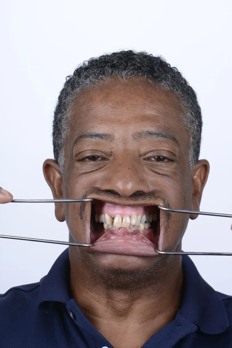 Before - Dental implant transformation - full smile restoration