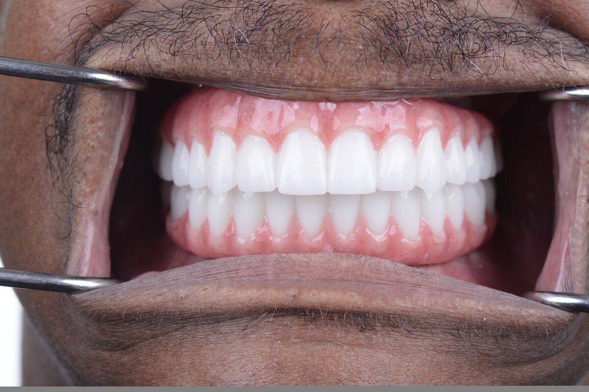 Patient 7 teeth after full mouth reconstruction