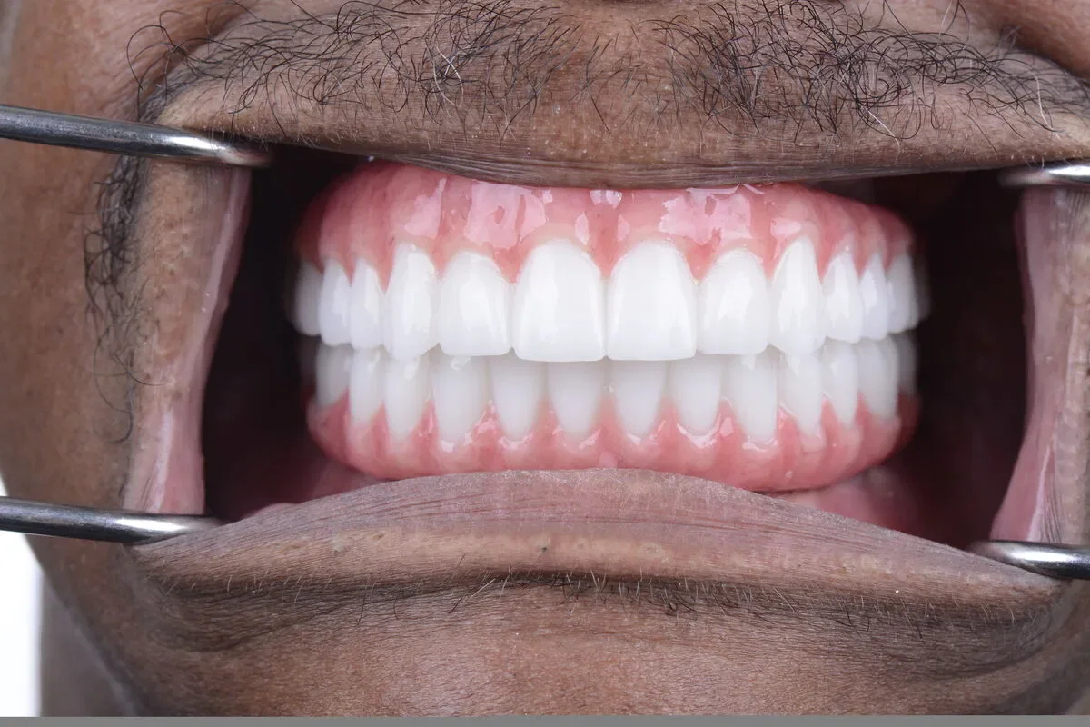 After teeth close-up - Dental implant transformation - full smile restoration
