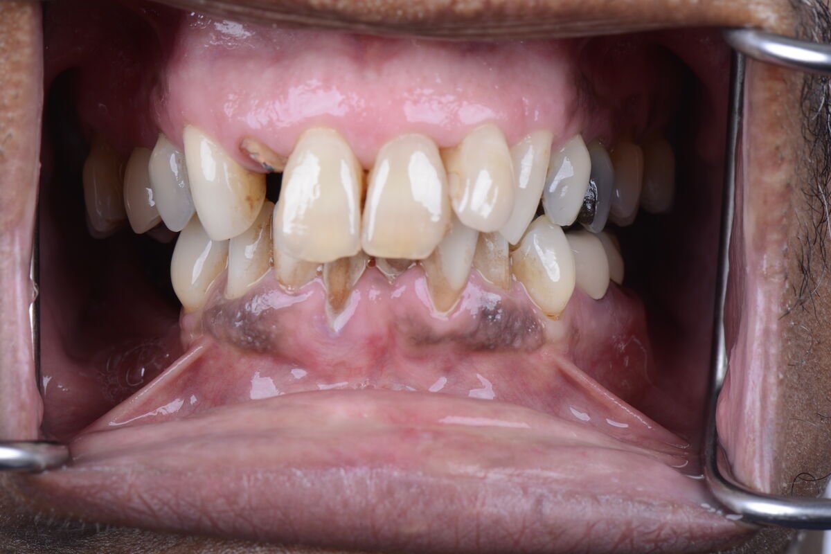 Patient 7 teeth before full mouth reconstruction