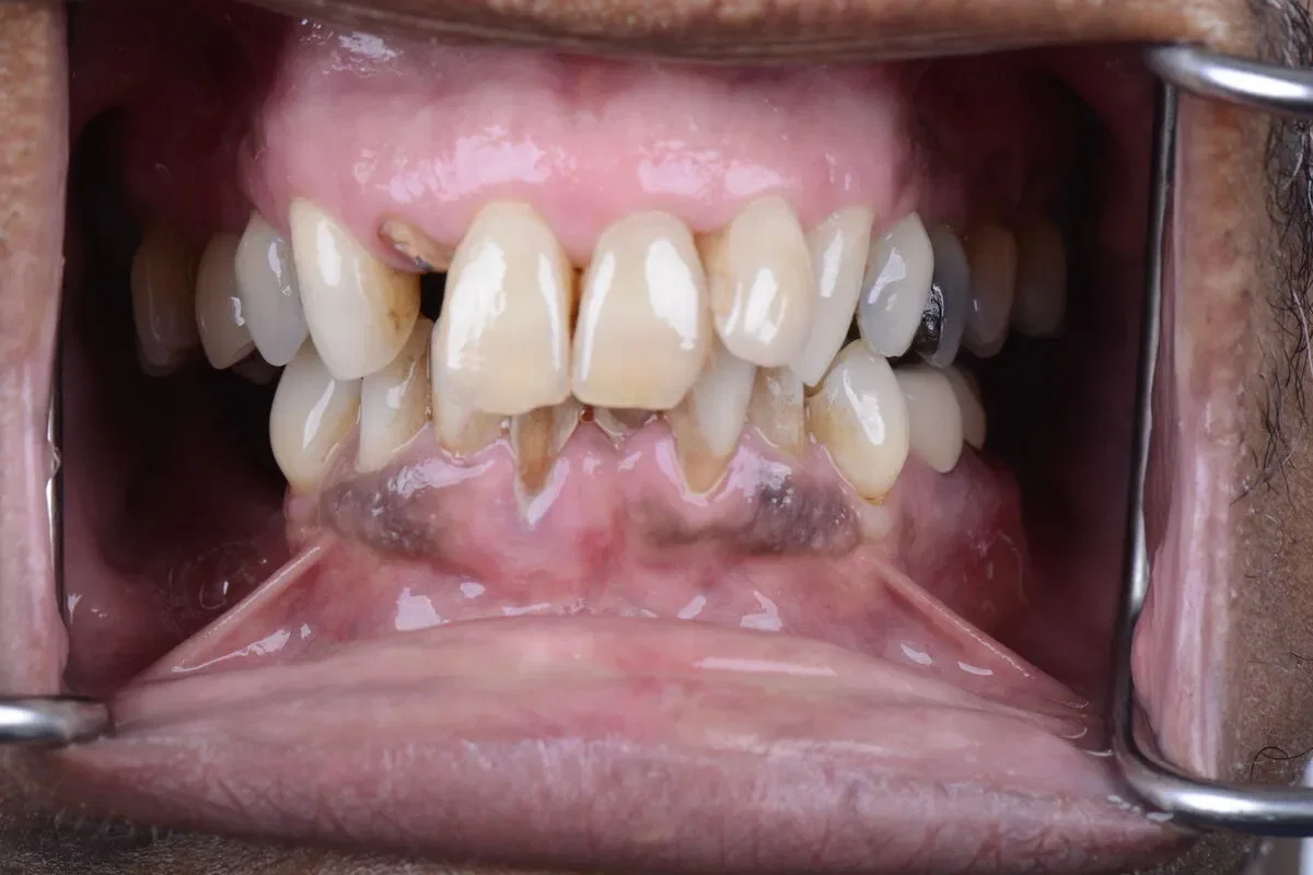 Before teeth close-up - Dental implant transformation - full smile restoration
