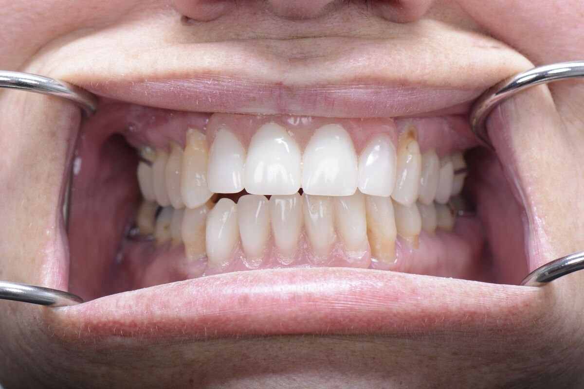 Patient 8 teeth after dental implant surgery