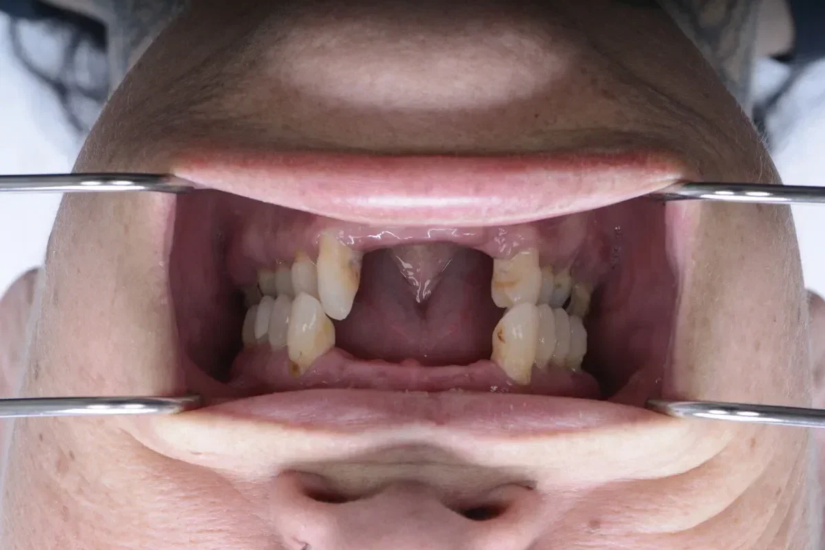 Before teeth close-up - Dental implant transformation - confident new smile