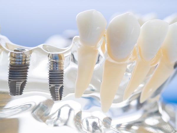 Modern dental implants compared to traditional dentures