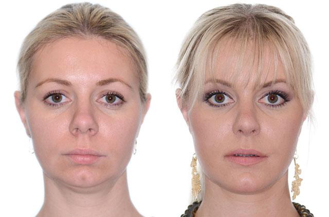 Corrective Jaw Surgery Complete Face Makeover