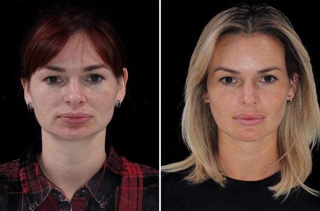Face Lengthening and Advancement - Aesthetic Jaw Surgery
