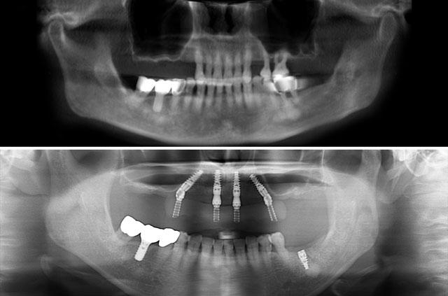 Immediate Implants and Teeth All-On-4 on Upper Jaw