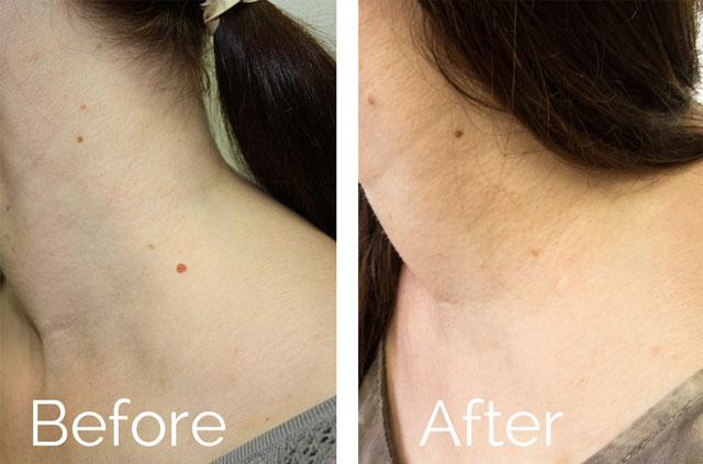 Neck Scarless Mole Removal