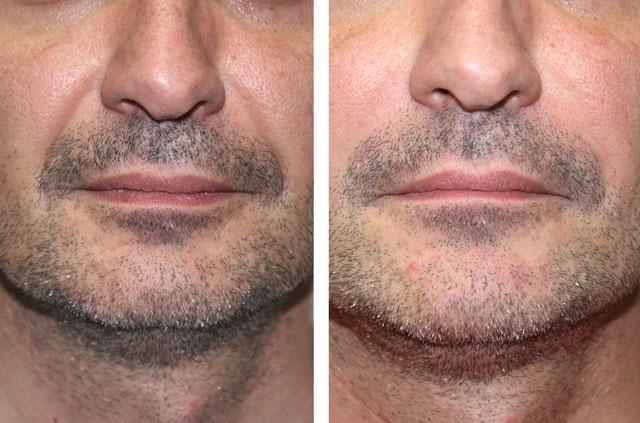 Dermal Fillers Juvederm