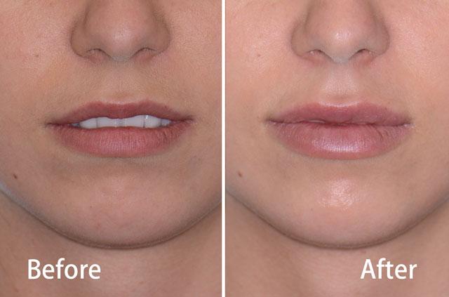 Juvederm Lips Fillers