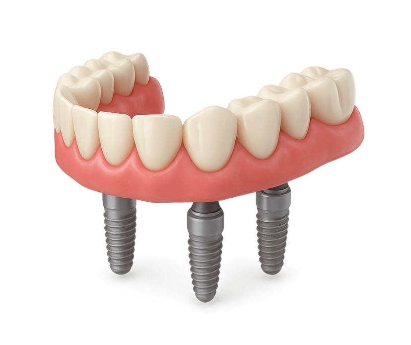 Full-Arch Implants