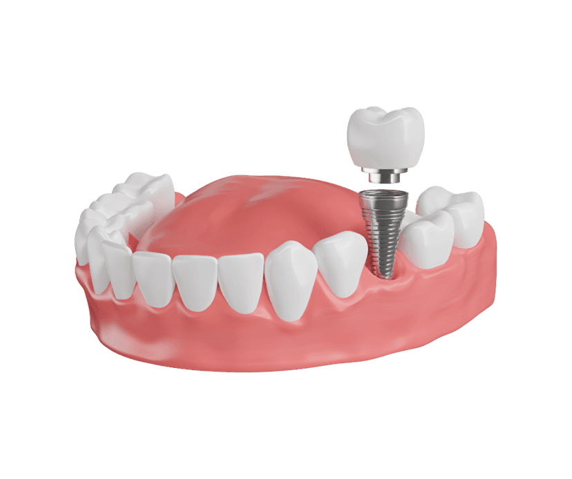 Single Tooth Implant