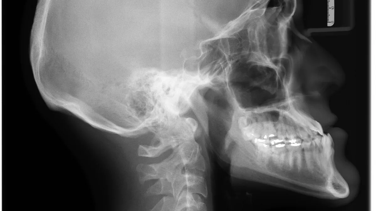 Bone Grafting for Dental Implants: What to Expect