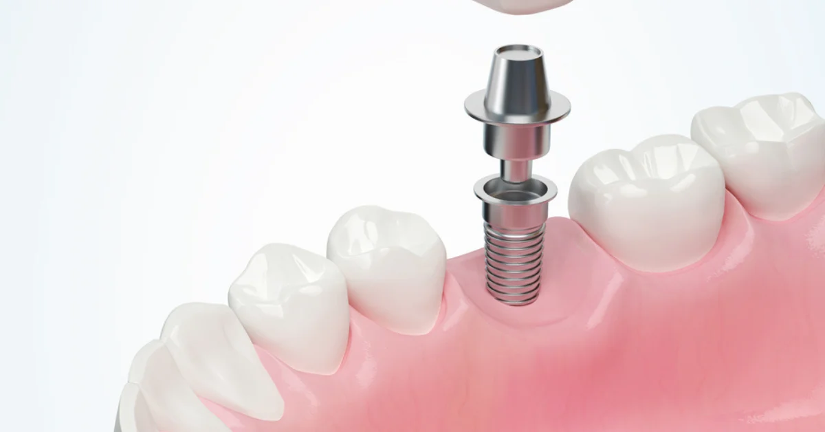 Dental Implant Crown vs Abutment: What Each Part Does and Why It Matters