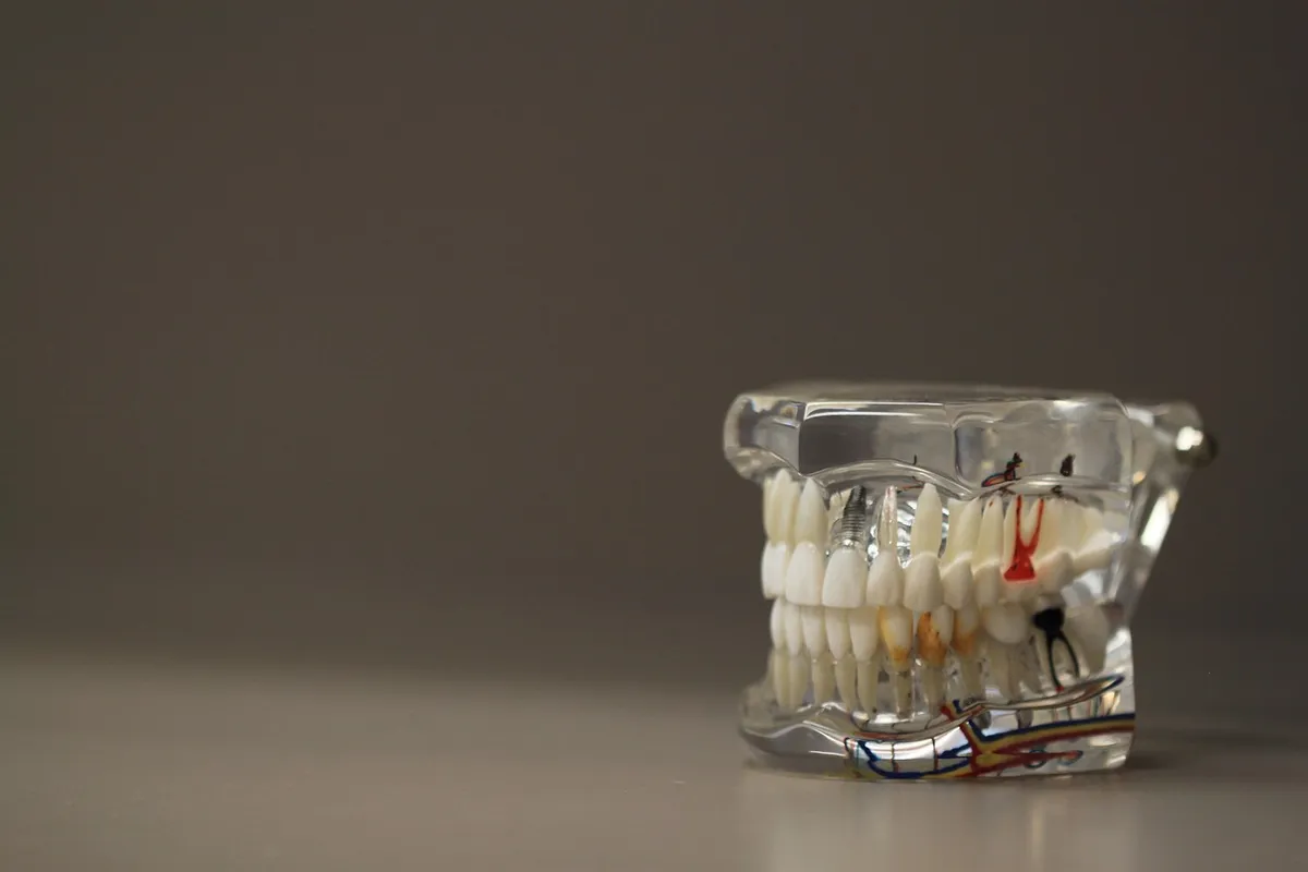 How Implant-Retained Teeth Beat Traditional Dentures