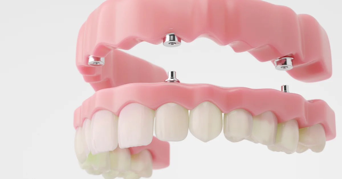 How Long Do Dental Implants Last and Why