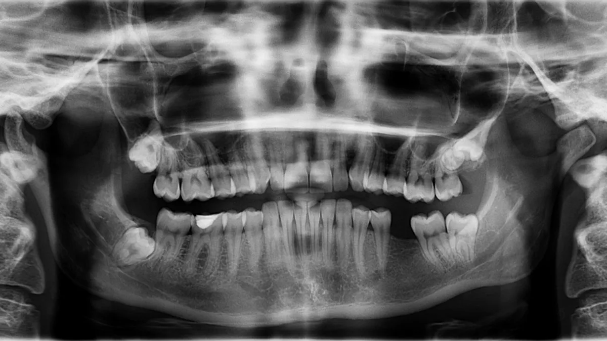 Why Dental Implants Fail and How to Prevent It
